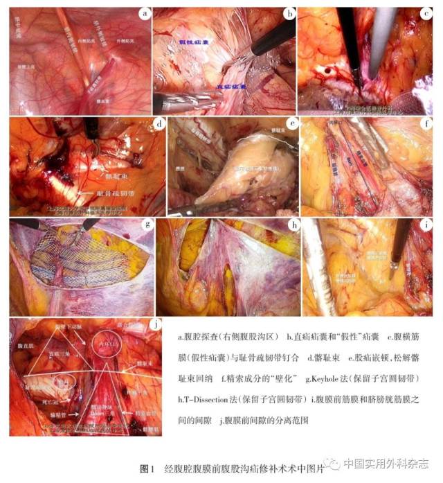 术式介绍|腹腔镜腹股沟疝修补术(本文配发视频)