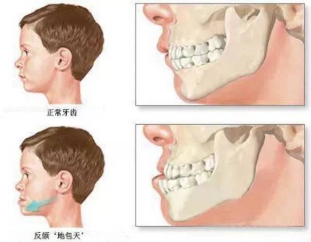 3)牙齿咬合太深(深覆合)整完牙以后会对下巴的形状有改变.