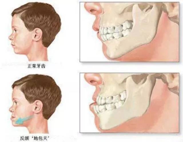 2)如果是地包天的话那是对脸型有改变 ..