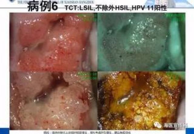 尖锐湿疣; 5,可疑阴道腺病,阴道恶性肿瘤; 6,宫颈,阴道及外阴病变治疗