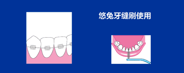 医生,我戴牙套后反而蛀牙变多了,怎么办?_手机搜狐网