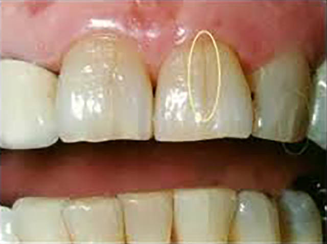 牙隐裂的裂纹常深入到牙本质结构,是牙齿敏感及牙痛的原因之一.