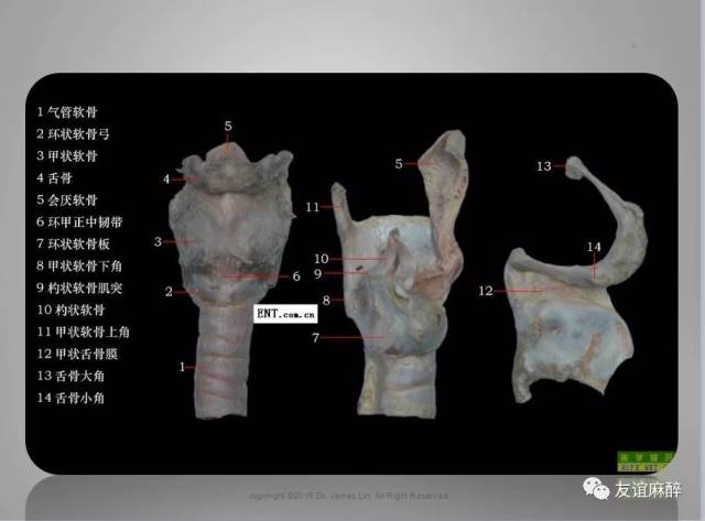 脱位类型 根据杓状软骨的左右解剖位置可分为:环杓关节左,右脱位.