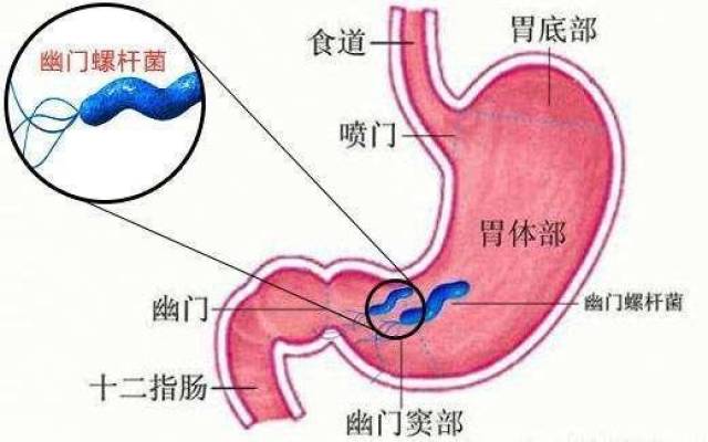 胃癌和饮食不当有关 少吃盐多喝牛奶 还要及时杀灭幽门螺杆菌