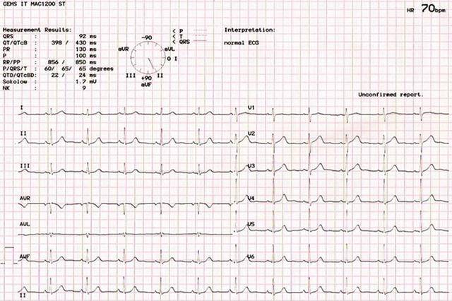 【每日一图】窦性心电图诊断标准