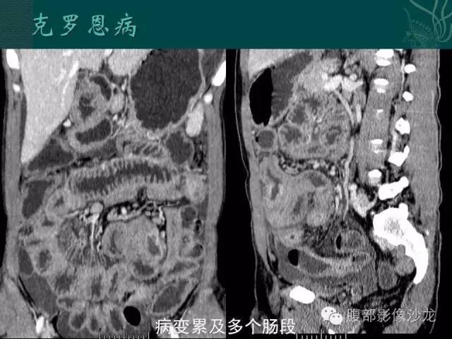 炎症性肠病的ct,mr诊断