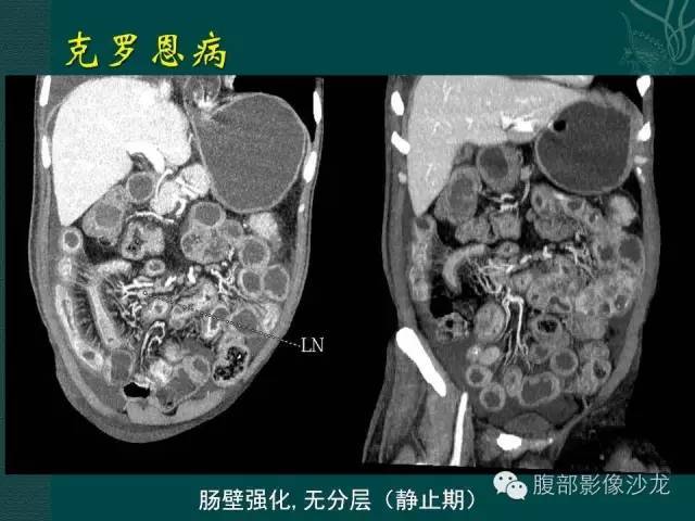 炎症性肠病的ct,mr诊断