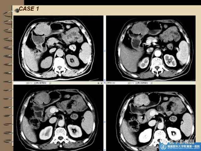 胃间质瘤的ct诊断与鉴别诊断 | 影像天地