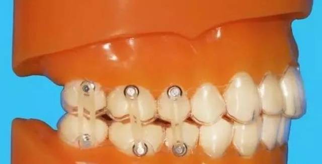 Ⅱ类牵引,Ⅲ类牵引:辅助牙齿移动,调整颌间关系.