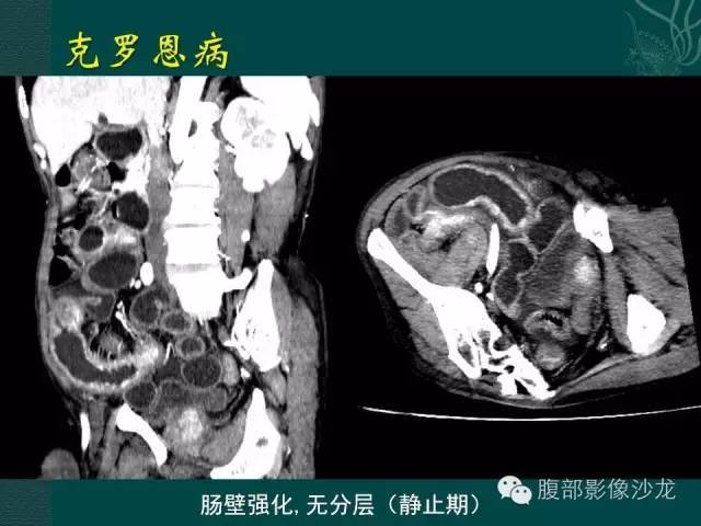 炎症性肠病的ct,mr诊断