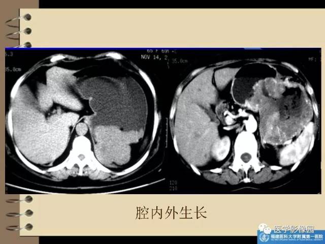 胃间质瘤的ct诊断与鉴别诊断 | 影像天地