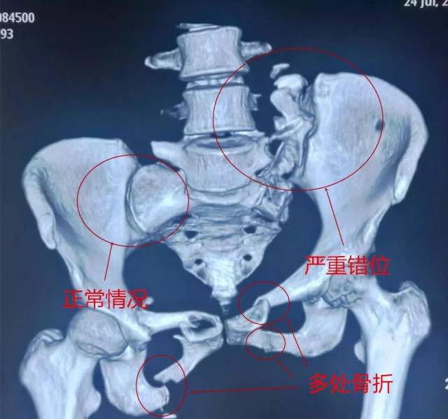 创伤骨科主任张锡平介绍,骨盆骨折是一种严重创伤,也向来是骨科最