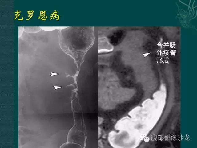 炎症性肠病的ct,mr诊断-搞笑频道-手机搜狐