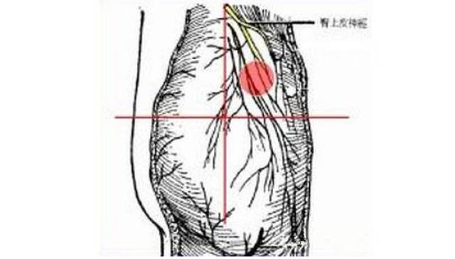 臀上皮神经卡压综合征【腰臀部疼痛针刀治疗】