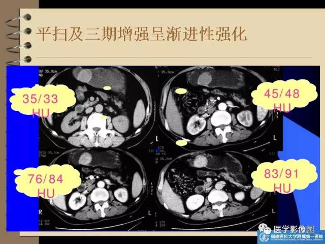 胃间质瘤的ct诊断与鉴别诊断 | 影像天地