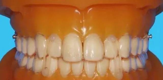 Ⅱ类牵引,Ⅲ类牵引:辅助牙齿移动,调整颌间关系.