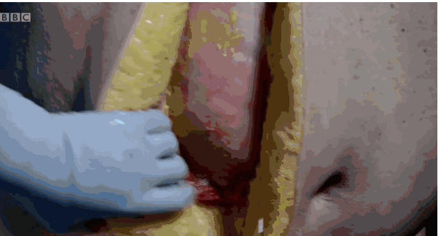 bbc解剖了一个200斤的女子,看完再也不敢乱吃东西了