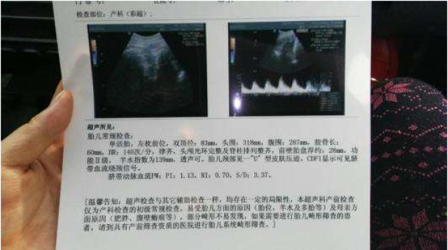 (2)先天全盲或小眼症:胎儿在子宫内因为没有光线的刺激,因此不会睁开