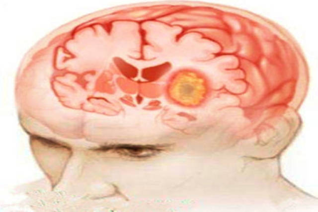脑干胶质瘤有哪些症状,又分为几类?_手机搜狐网