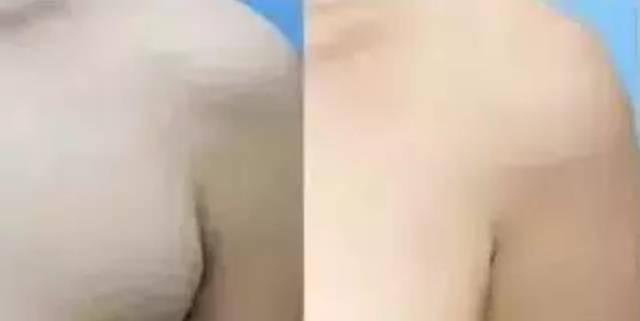 又称为假性副乳,这类副乳没有乳腺,乳橥 .