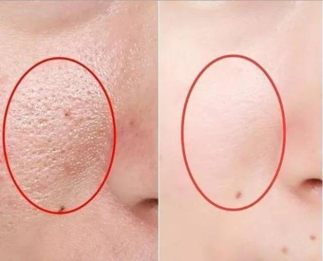 就算是没有明显的体重增加,耳垂到下巴的线条也逐渐开始变得松松垮垮