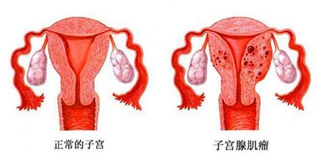 子宫腺肌症有没有自愈的可能性?