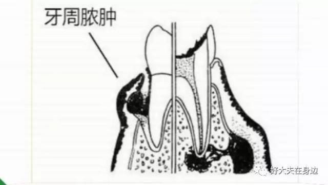 引起牙龈肿痛的原因主要包括牙龈脓肿,牙周脓肿,智齿冠周炎或根尖周炎