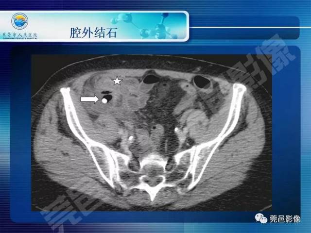 急性阑尾炎的ct表现