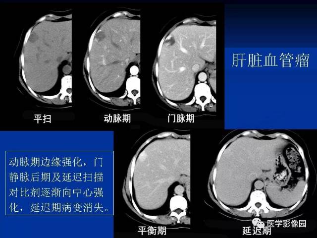 肝脏血管瘤影像学表现及鉴别诊断(一 影像天地