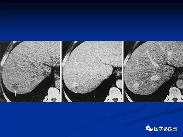 肝脏血管瘤影像学表现及鉴别诊断(一 影像天地