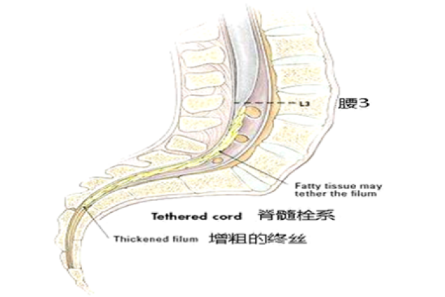 脊髓栓系综合征的鉴别诊断