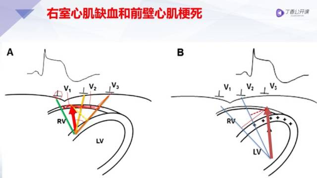 一文搞定右室心梗与前间壁心梗