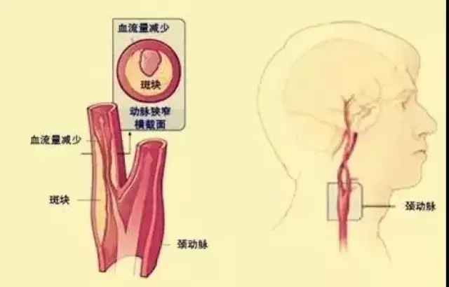 猛回头这一动作,可能造成颈动脉内不稳定的斑块"受刺激"脱落,会给心脑