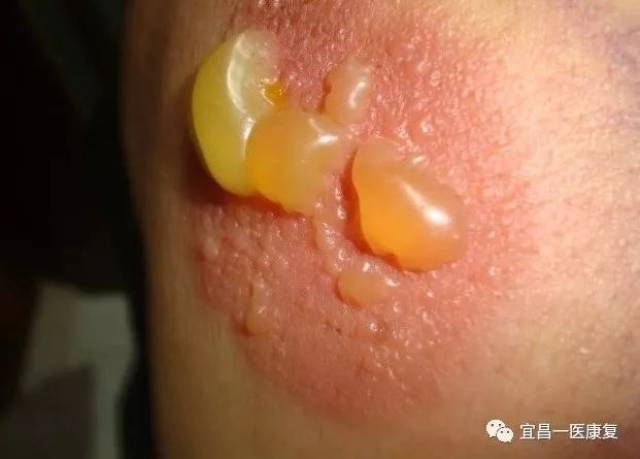 贴三伏贴起水泡怎么办?