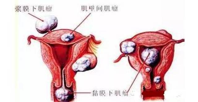 子宫肌瘤谁割谁后悔看看她你就懂了