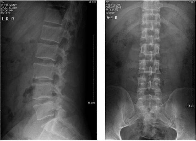 腰椎正位: 多显示腰椎侧弯征,椎间隙宽度于病变早期多无改变;如病程