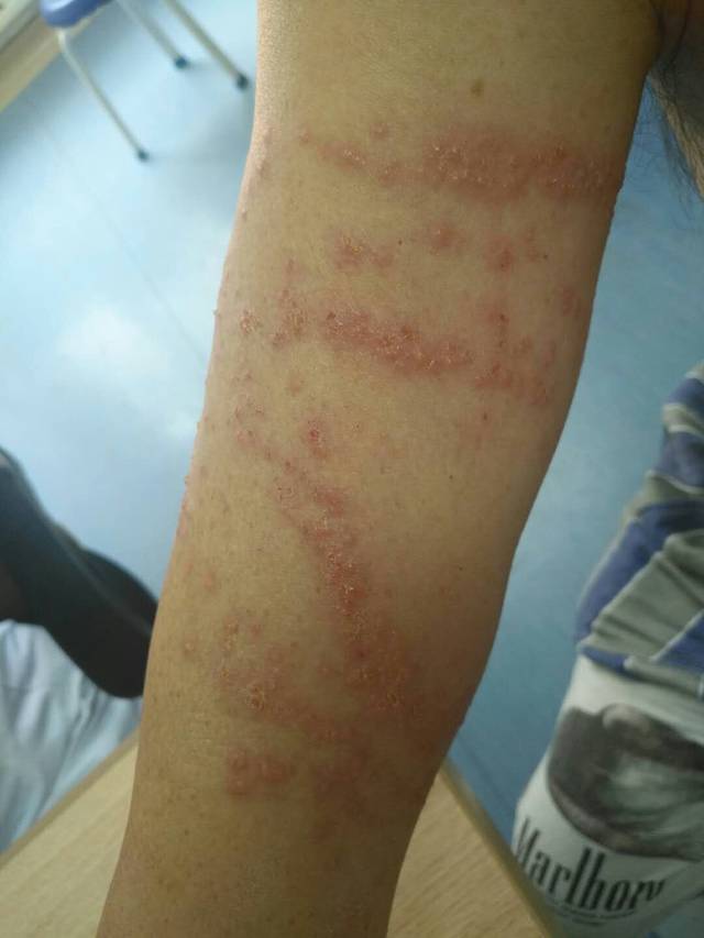 诊治:这是典型的被海蜇蜇伤后的海蜇皮炎反应.