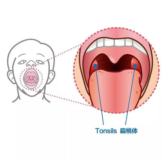 【小南话科普】你的扁桃体究竟需不需要割?