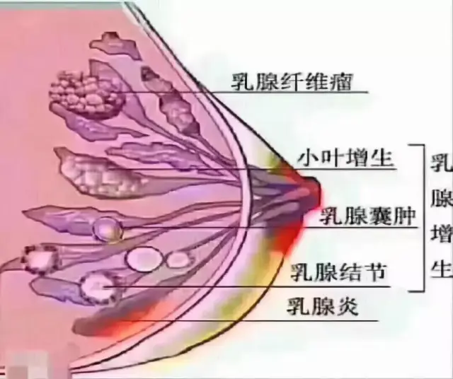先是从乳腺增生—乳腺结节—乳腺纤维瘤—乳腺癌,都是这样一步步演变