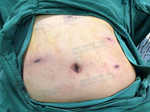 腹壁有4~6个5~12mm的小切口,短时间内还是容易看出手术留下的小疤痕