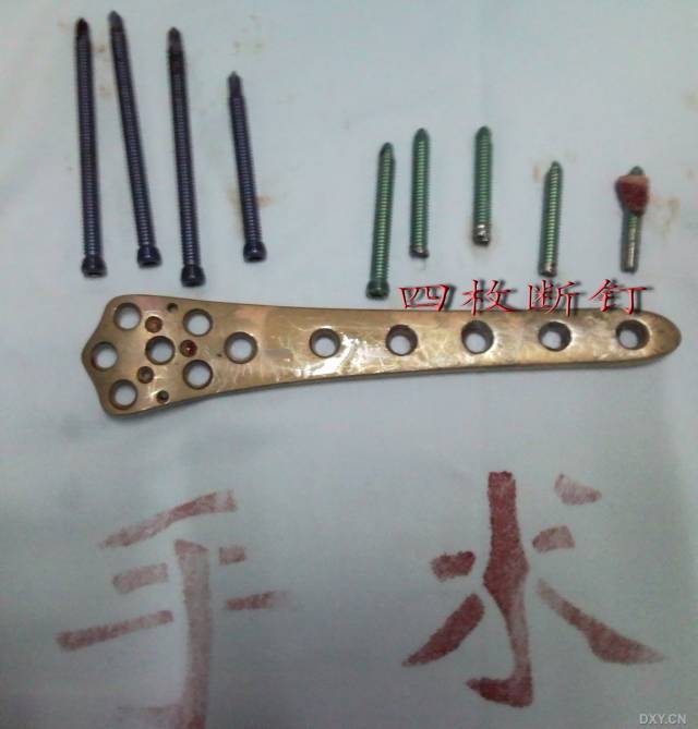 先看看取出的钢板螺钉