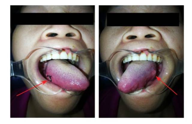 右侧舌癌(左) 左侧舌癌(右)