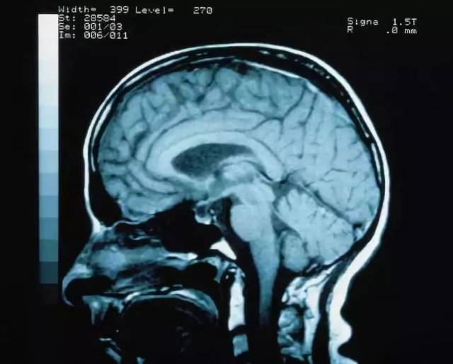 核磁共振下的脑部图像