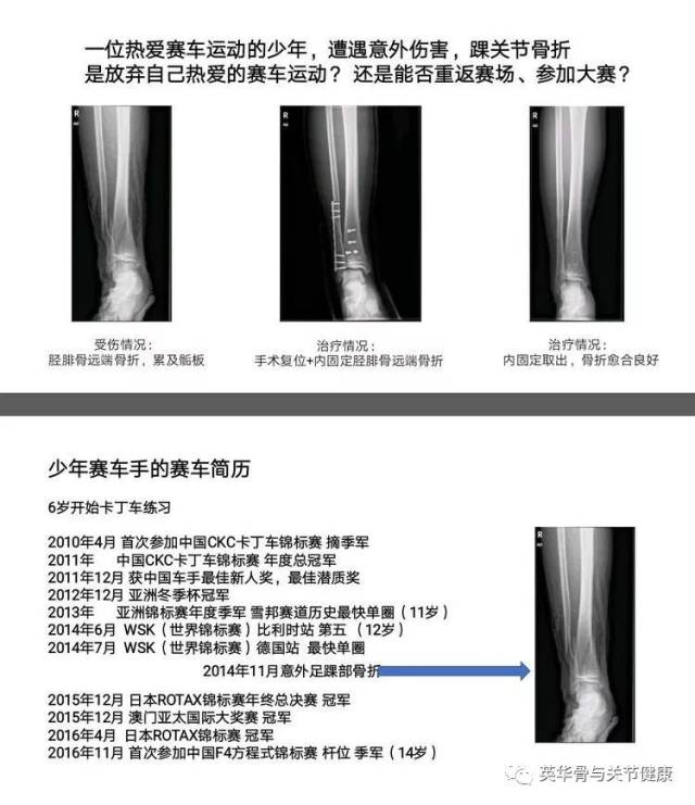 孩子骨折了,需要手术吗?