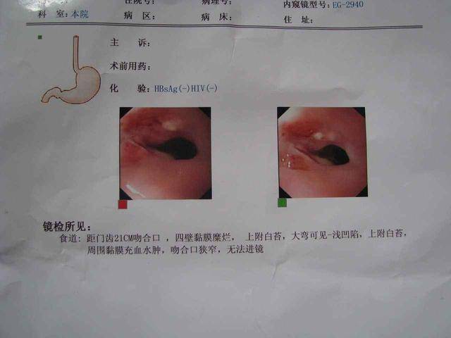 食道癌复查报告