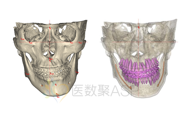 数字化正颌外科治疗——偏颌畸形案例