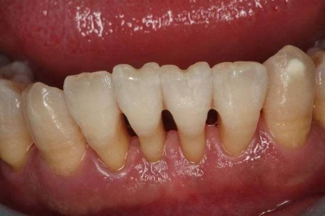 引起牙周病的原因是什么?_手机搜狐网