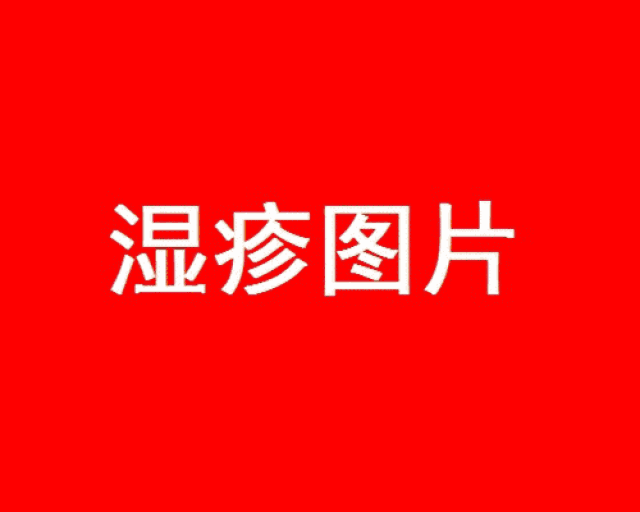 湿疹和痱子,你会正确的区分和应对吗