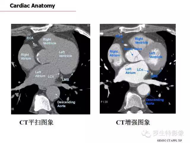 心脏ct断面解剖