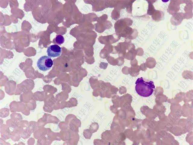 【延伸阅读】 骨髓细胞形态·正常 典型狼疮细胞(lec) 典型的狼疮